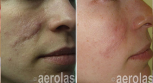 scar-improvement