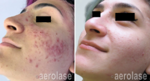 scar-reduction
