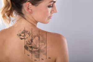 Tattoo Removal at The Devonshire Clinic, Dermatologists London