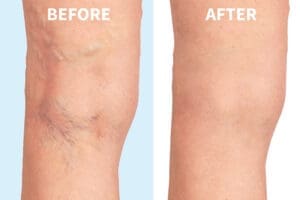 Blood Threads Thread Veins: Causes, Treatments & What to Expect