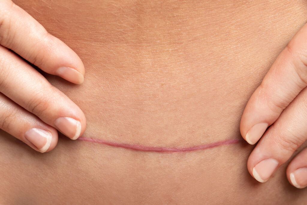 c-section scar 